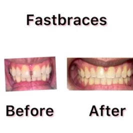 Fastbraces